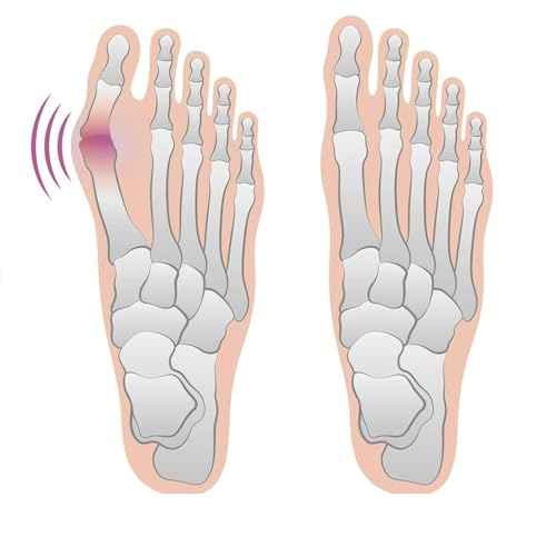 4 Bunion Relief Pads and Sleeves, Orthopedic Bunion Corrector Socks with Gel Pads, 2 Pairs