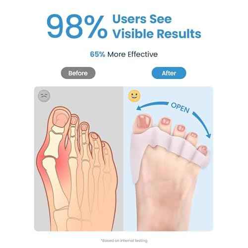 Toe Separators - Podiatrist Recommended, Toe Spacers for Men and Women, Breathable Bunion Corrector