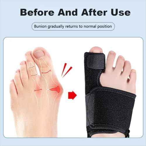 Bunion Corrector for Women & Men, 2pcs Bunion Fix & Big Toe Straightener, Orthopedic Bunion Splint Brace for Hallux Valgus Pain Relief, Day & Night Support